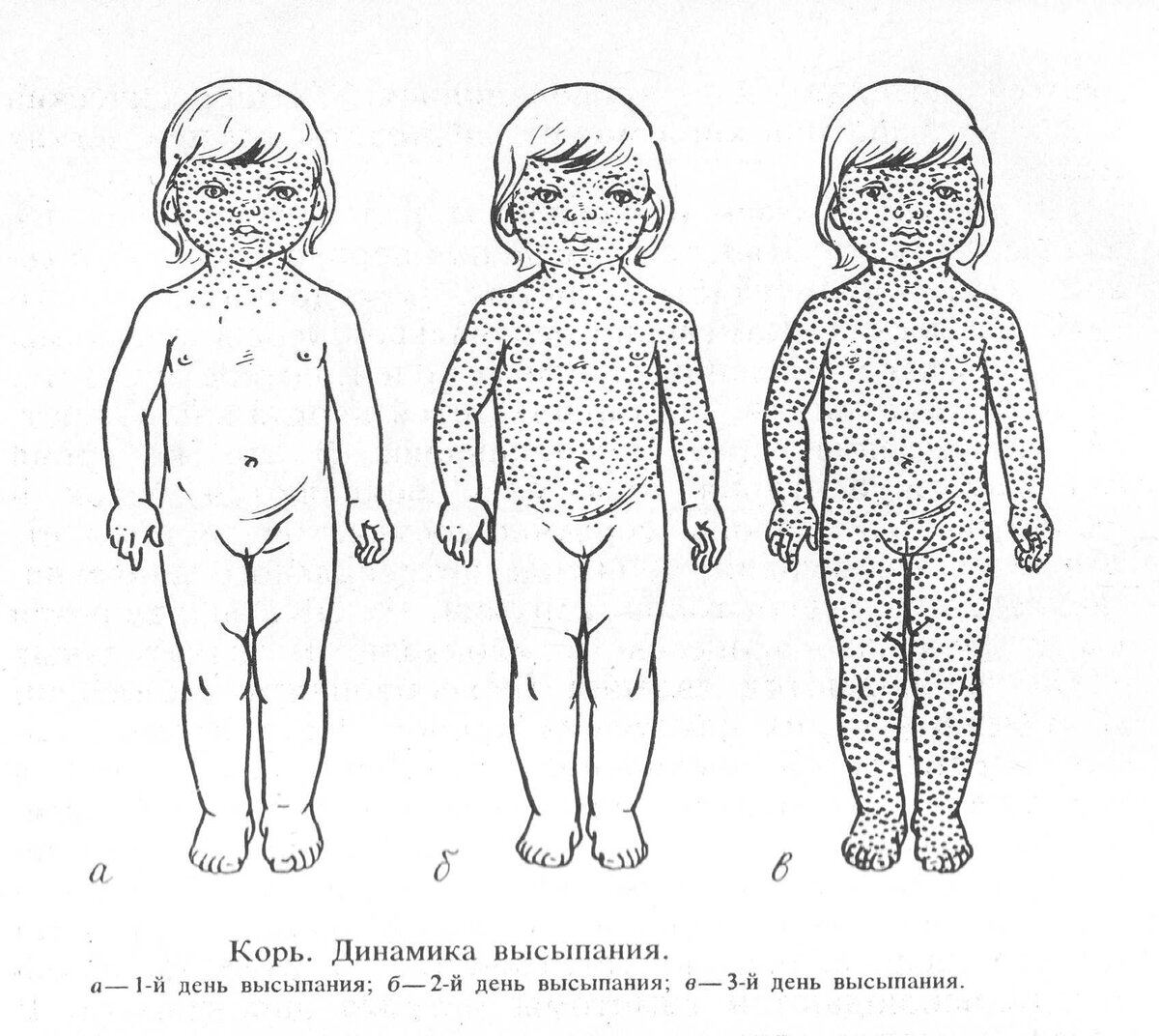 Эпидемия кори - как себя обезопасить? | Мама Гоги | Дзен