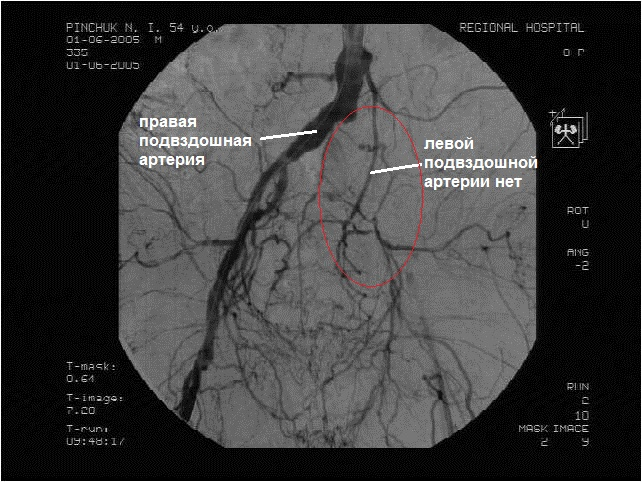 Кт-ангиография артерий нижних конечностей. Атеросклероз бедренной артерии на кт. Тромбоз артерии ангиография. Ангиография бедренной артерии тромб. Тромбоз артерии мкб 10