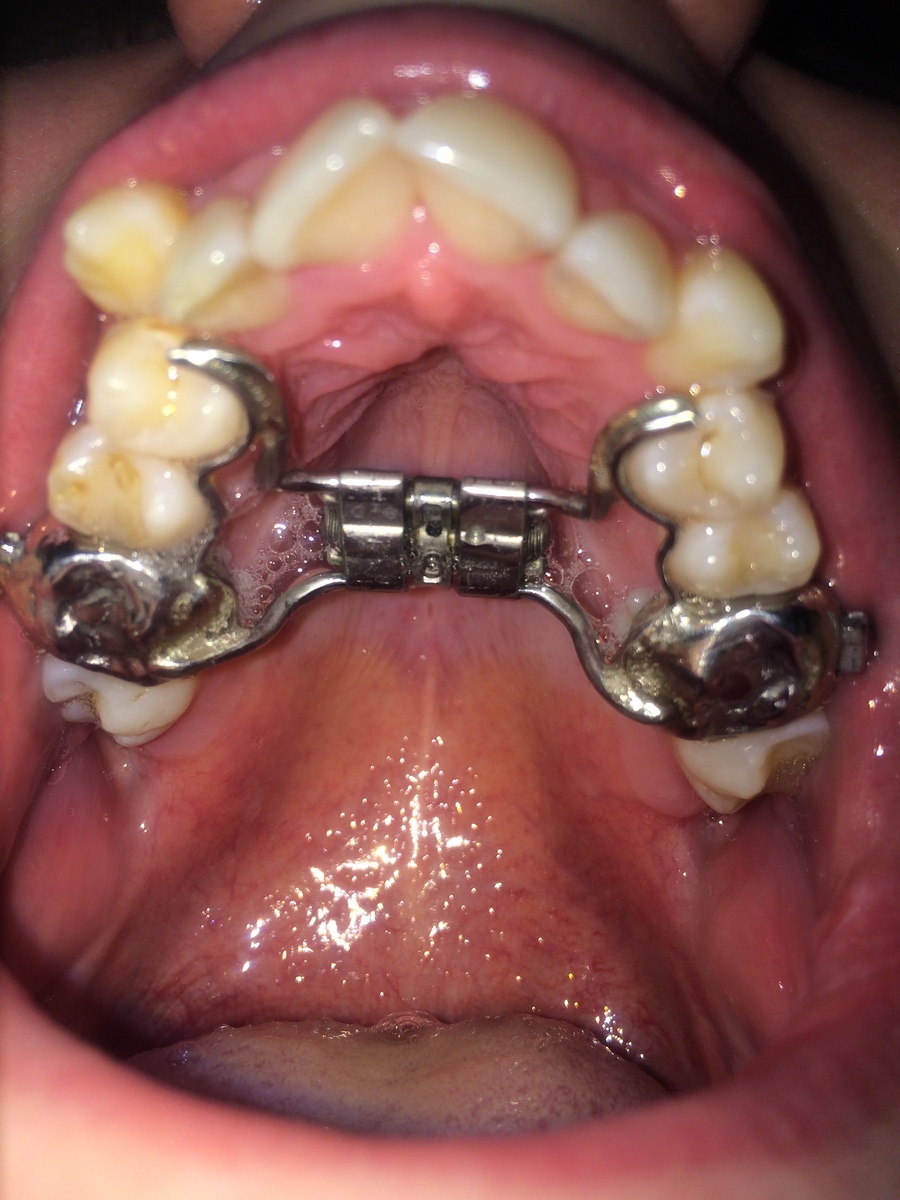 20.02.2015- Винт-Хайрекс в моей челюсти, фото после установки. 