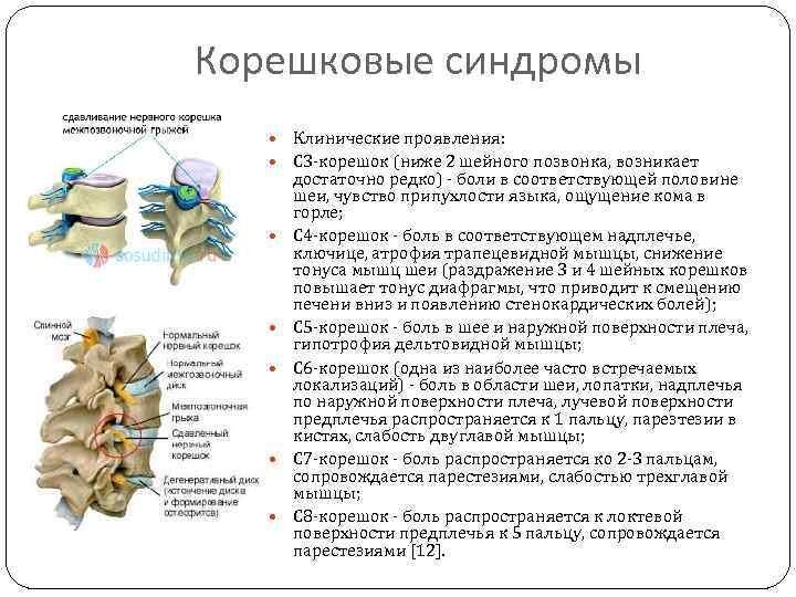 Корешок с1 поясничного отдела позвоночника. Корешковый синдром шейного отдела с4. Корешковый синдром с6. Корешковый синдром поясничного отдела позвоночника схема.