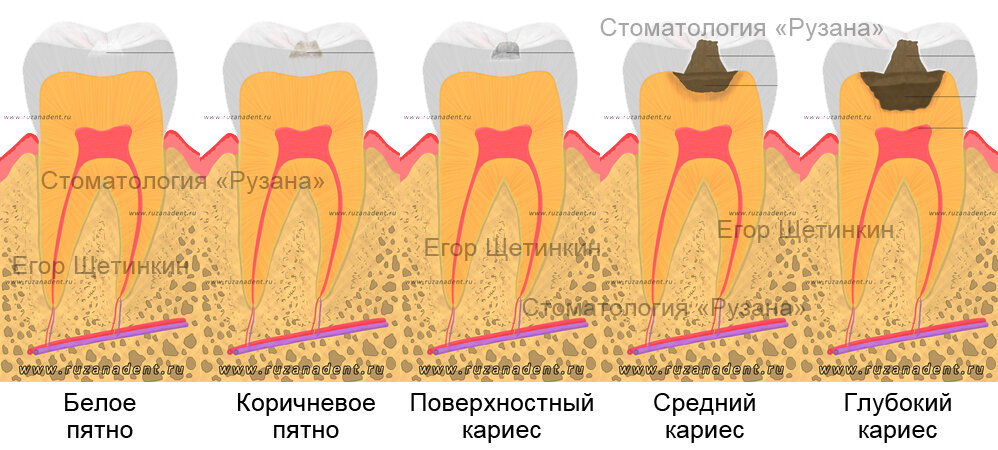 Cuantas caries se pueden tener