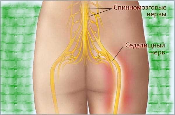 Почему болит седалищный нерв при беременности?