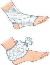 Первая помощь при растяжении связок