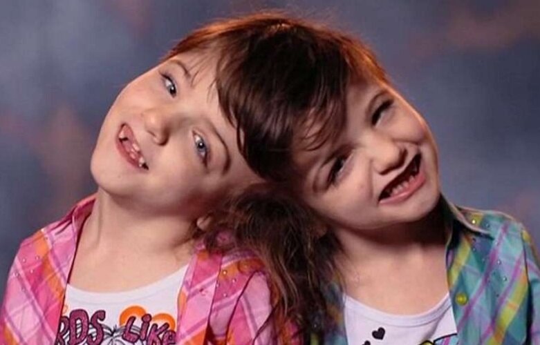 Криста и Татьяна Хоган разделяют вкус, зрение, чувства и мысли. Вот на ...