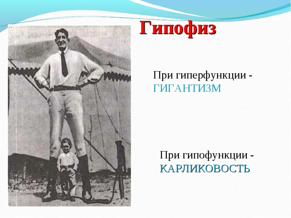 Презентация гигантизм и карликовость