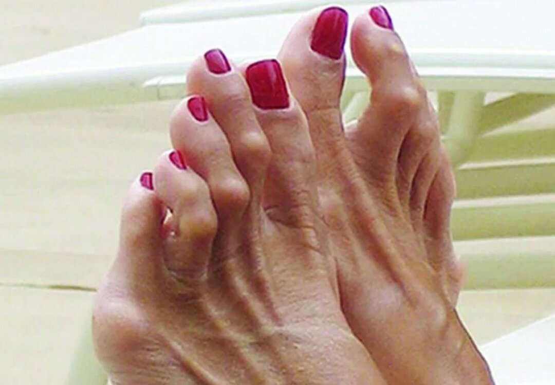 Молоткообразная форма пальцев при тарзальном синдроме