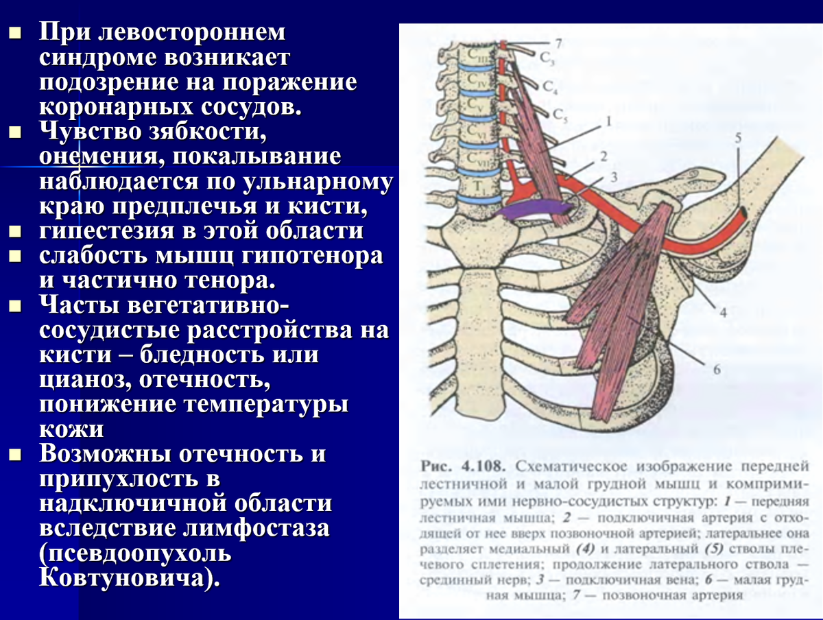 Симптом лестничной мышцы. Синдром передней лестничной мышцы. Передняя лестничная мышца синдром. Передняя средняя и задняя лестничные мышцы.