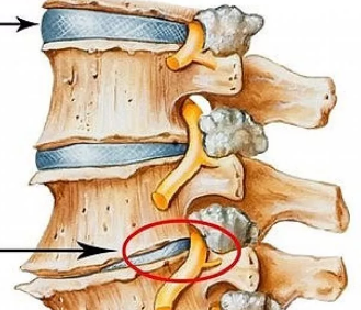 Нормальный и поврежденный межпозвоночные диски.