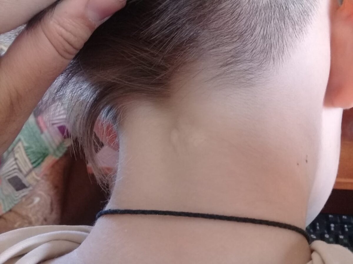 Шрам от гемангиомы. Он почти плоский и светлый