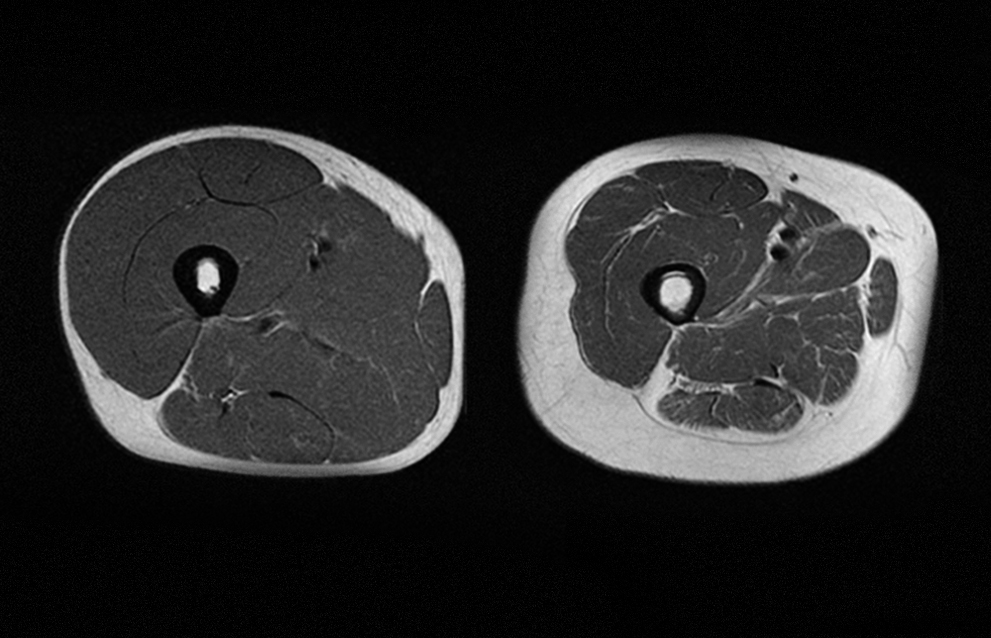 На картинке мышечная масса в области бедра в возрасте 25 лет и состояние в возрасте 65 лет.