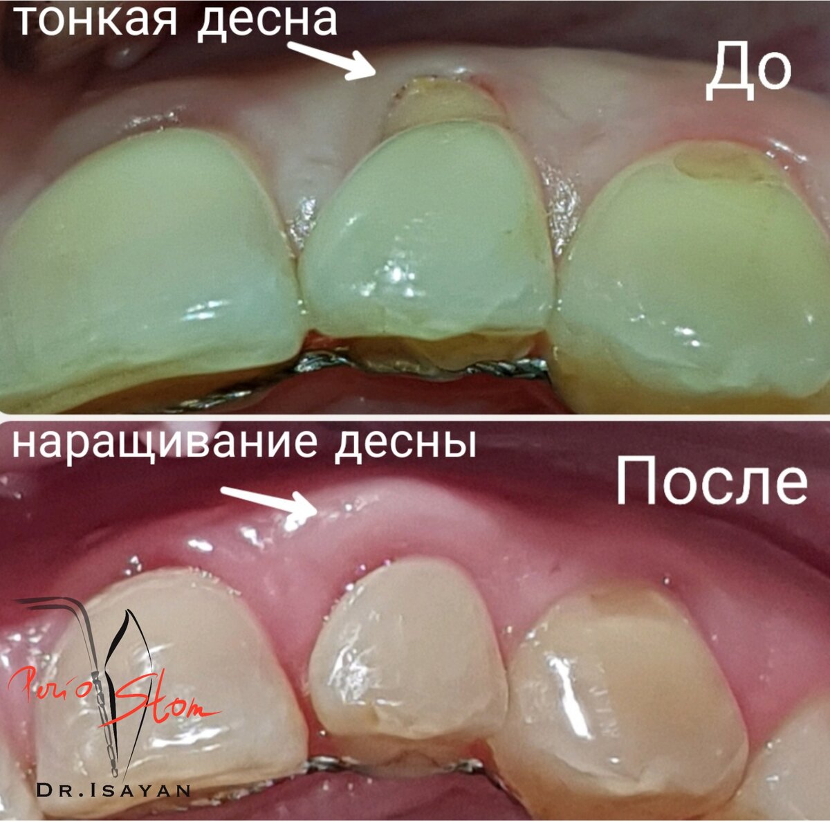 ЧТО ДЕЛАТЬ, ЕСЛИ ПРОИЗОШЛО ОГОЛЕНИЕ КОРНЯ ЗУБА?