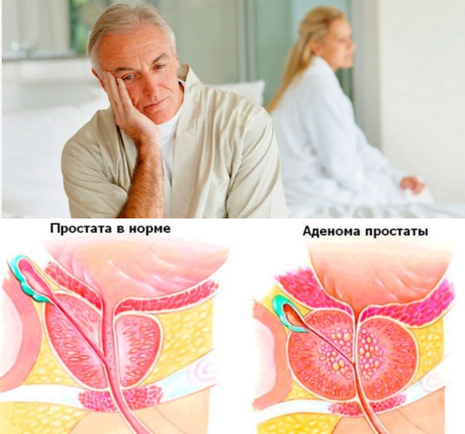 Аденома простаты