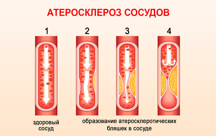 Схема: Атеросклероз в действии...