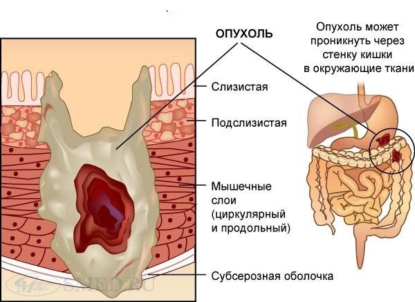 Онко Вики — Рак анального канала