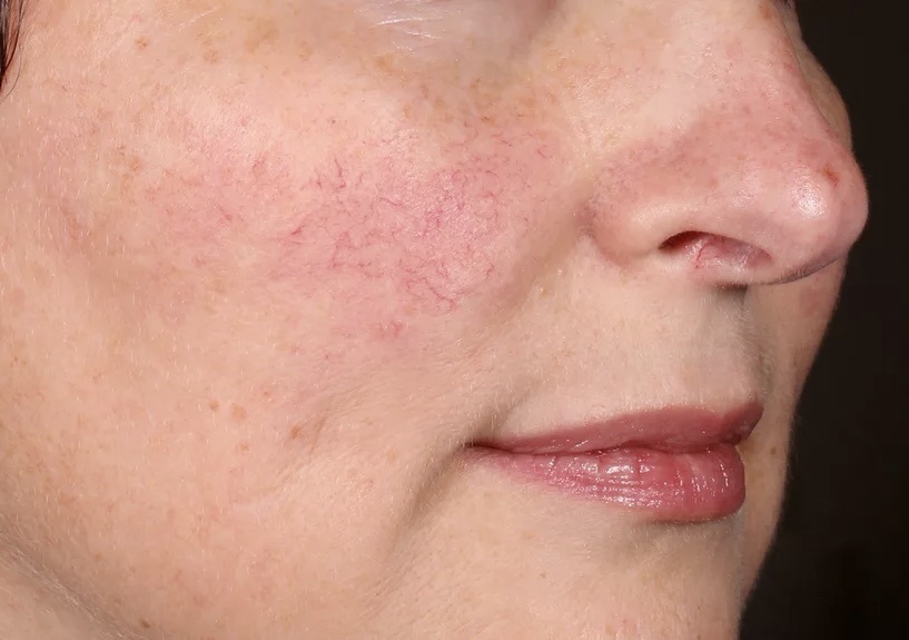 На этом фото ярко выраженный сосудистый рисунок - купероз.