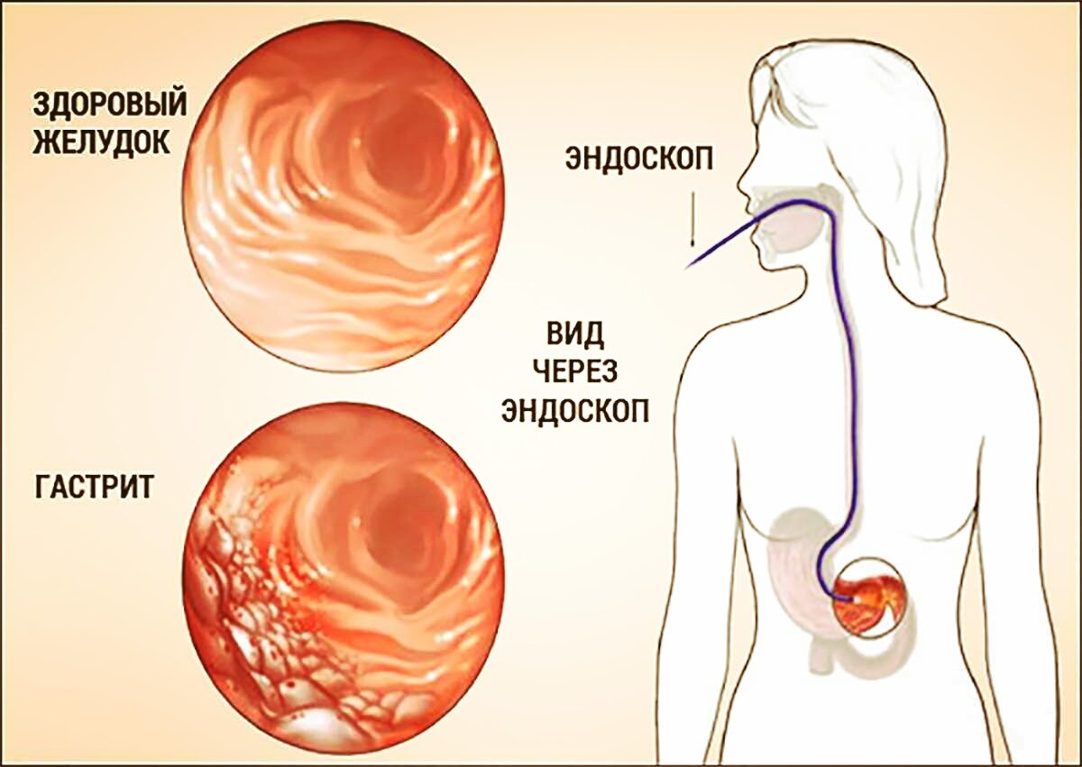 От чего гастрит