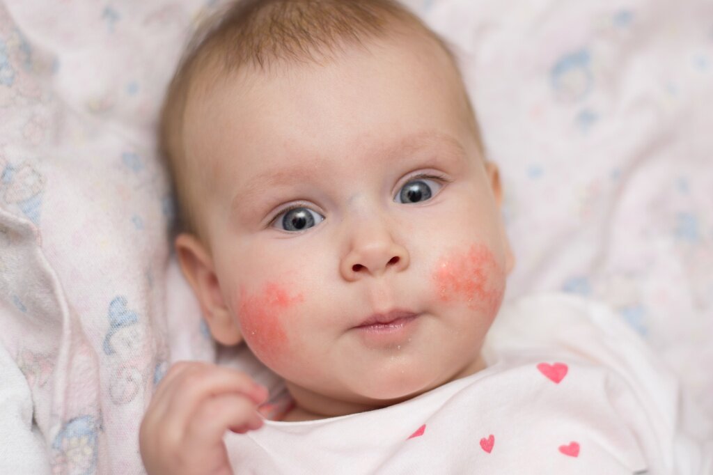 У ребенка красные щеки? А вы знаете, что это может быть признак серьезного заболевания? Узнайте, в чем причина проблемы и как с ней бороться.