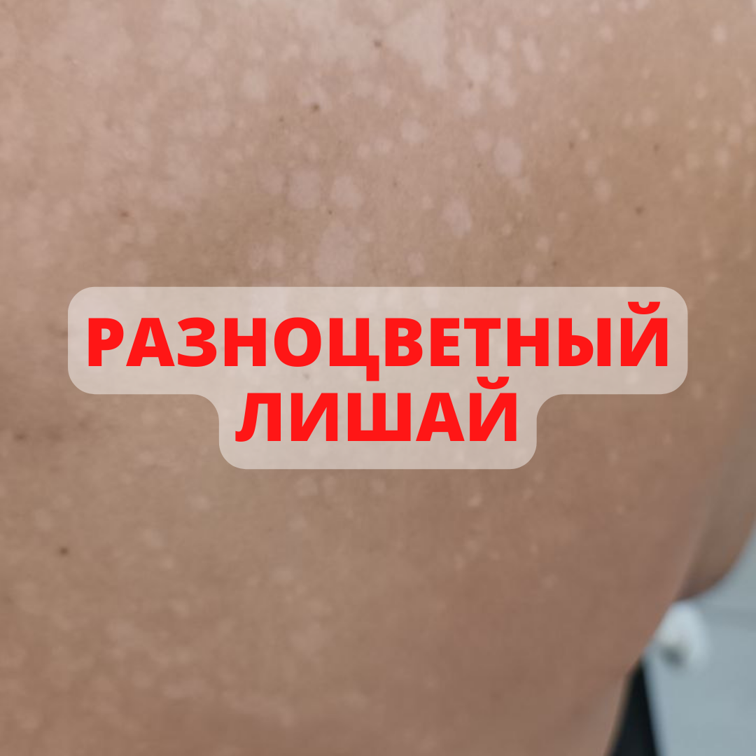 Разноцветный лишай (фото заболевания в конце) | Советы  дерматолога|Sovetydermatologa | Дзен