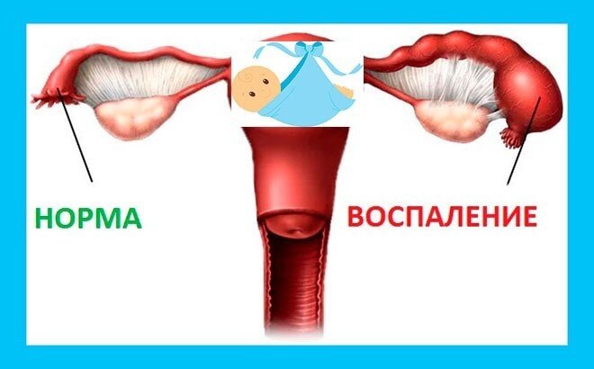 Почему болят яичники и что с этим делать