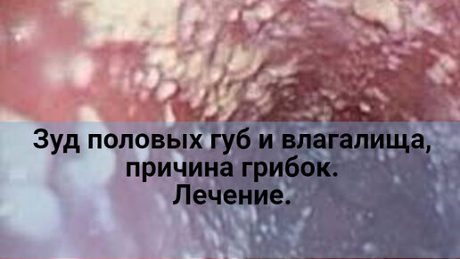 下载视频: Зуд половых губ и влагалища, причина грибок. Лечение.