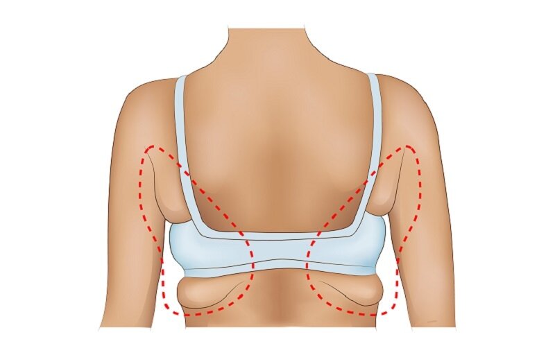 Как убрать жировые складки под мышками: лайфхаки
