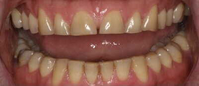 стираемость зубов при бруксизме