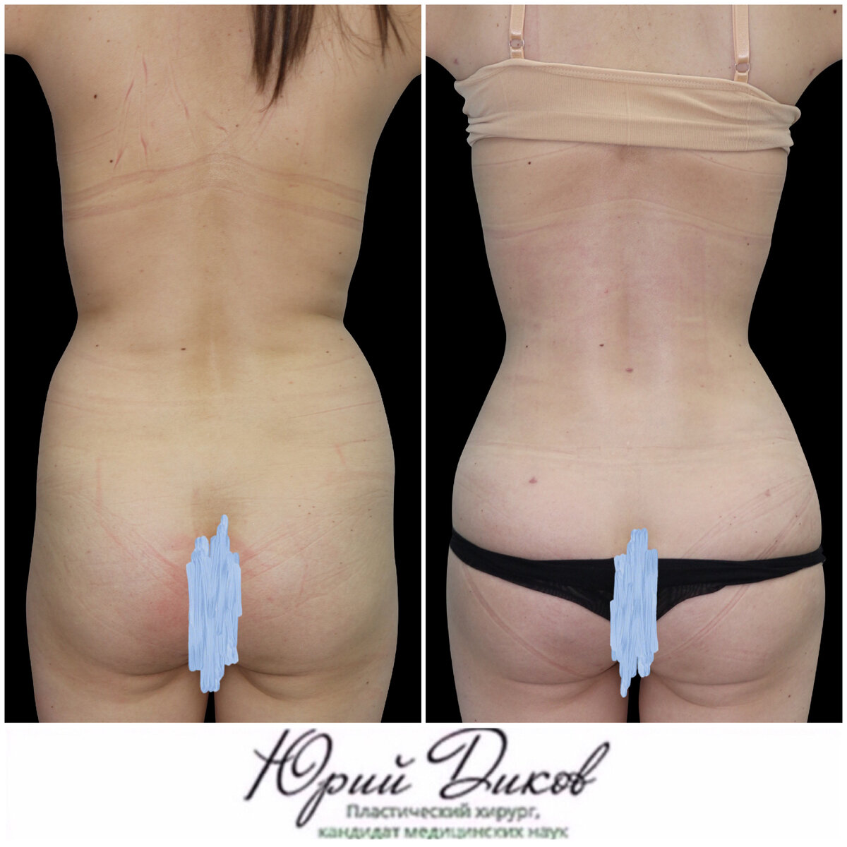 Мужская и женская липоскульптура: в чем отличие и сходство