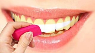 На наши зубы действует огромное количество различных красителей, из-за чего эмаль приобретает желтый, серый или другие оттенки. Отбеливание зубов помогает сделать зубы белыми.