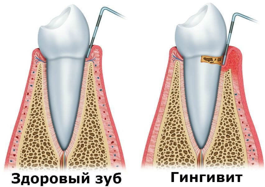 https://dental-media.ru/wp-content/uploads/2019/09/xronicheskiy-ploxoy-zapax-izo-rta-prichiny-2.jpg