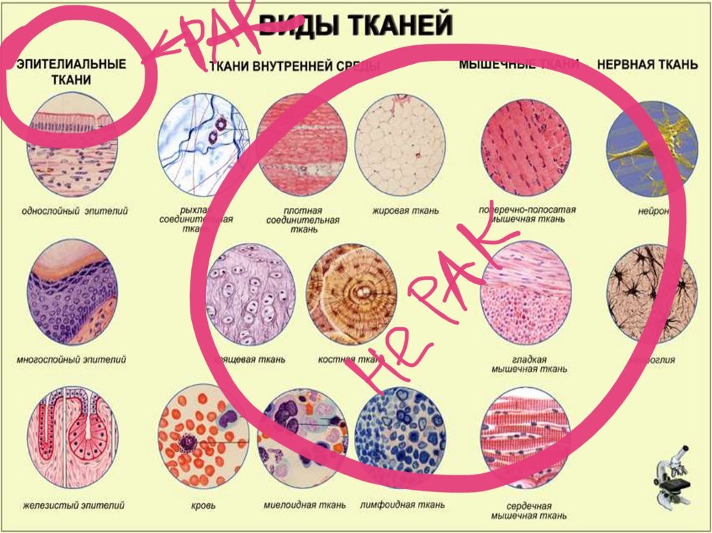 Опухоли могут возникать из любой ткани, но раком являются только опухоли из эпителия 