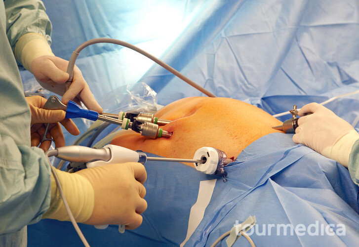 https://www.tourmedica.pl/photos/151/operacja-przepukliny-pachwinowej-laparoskopowo_150551_h500.jpg