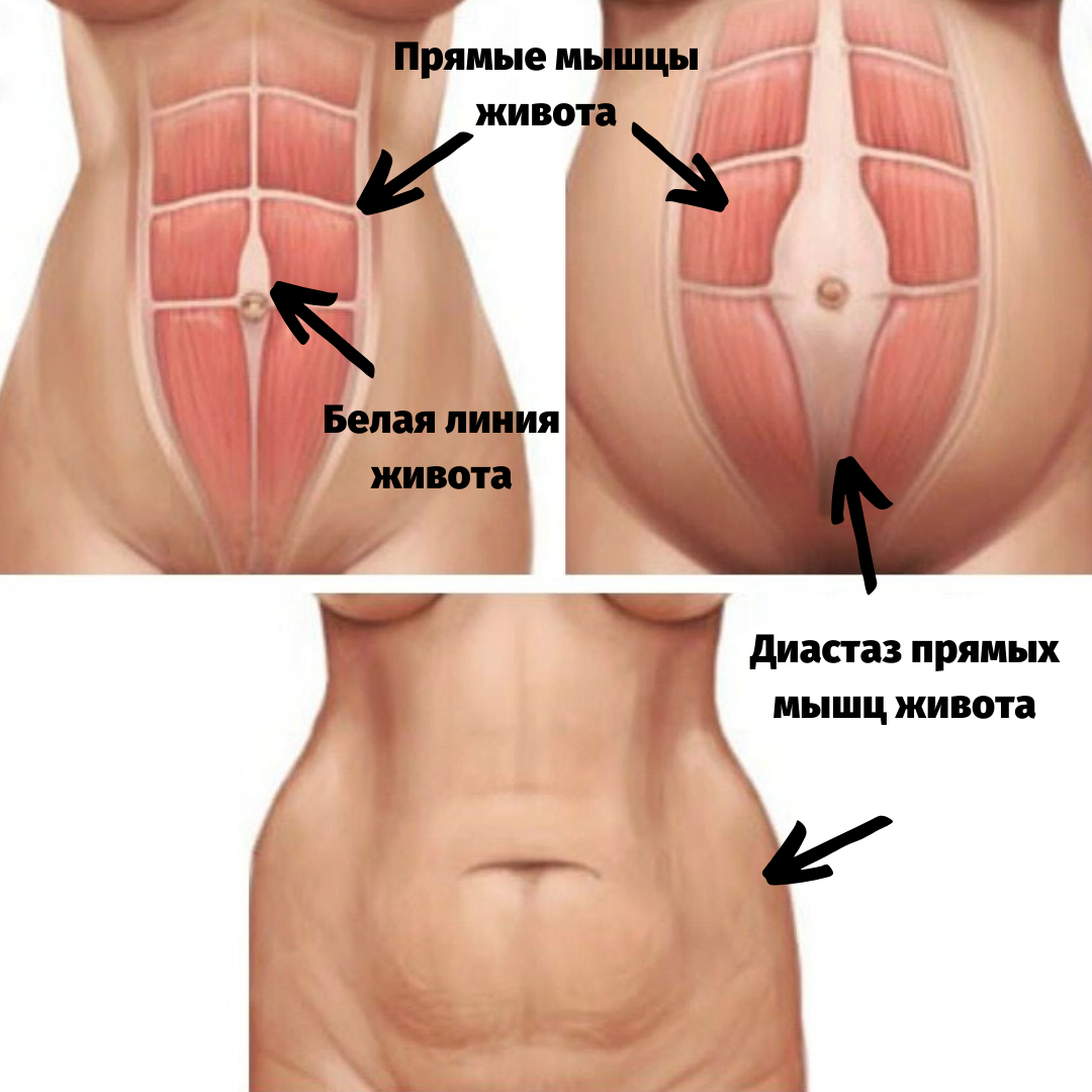 тянут мышцы живота при беременности