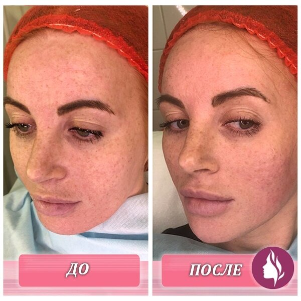 Радиез косметологический фото до и после