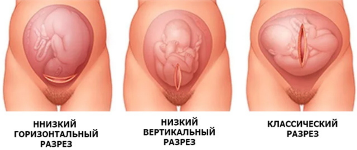 Кесарево сечение: необходимость или каприз?