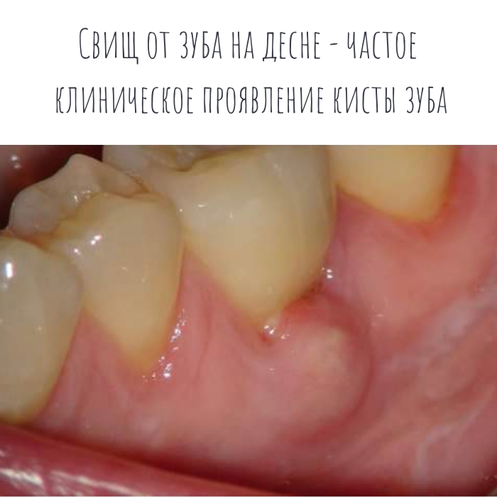 Лечение и удаление кисты зуба