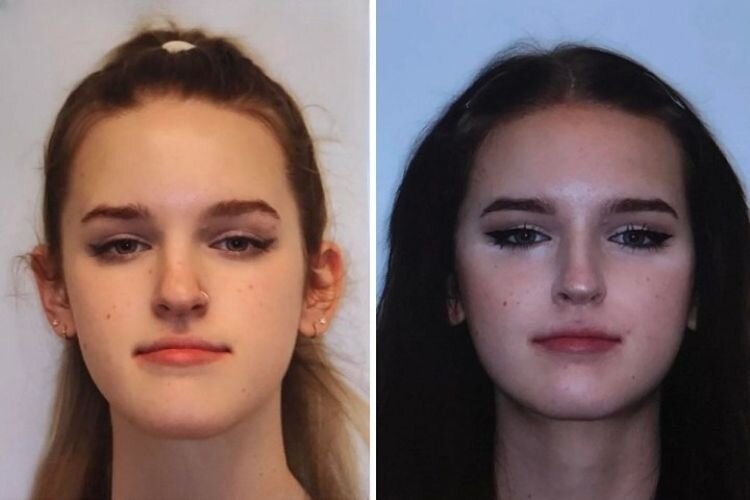 Источник: https://www.reddit.com/r/PlasticSurgery/comments/v80dqn/6_months_post_double_jaw_surgery