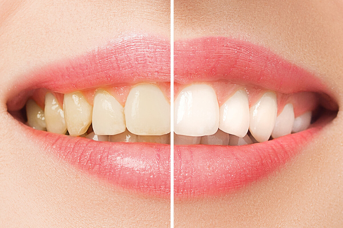 Надоели пожелтевшие зубы, всегда хотели иметь белоснежную улыбку, как у актрис в кино? Добиться такого результата без посещений дорогих стоматологов, теперь возможно в домашних условиях.