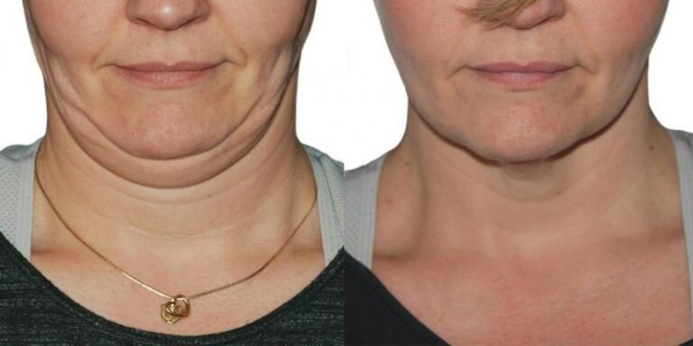 Как избавиться от второго подбородка в домашних условиях