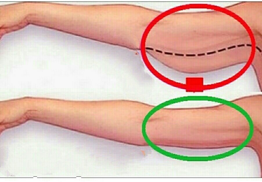 Посмотрите как можно убрать этот дефект без хирургического вмешательства