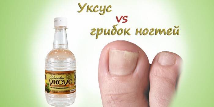 Как вылечить грибок на ногах: народные средства - Областная газета zelgrumer.ru