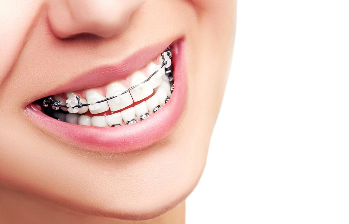 Stayed brackets