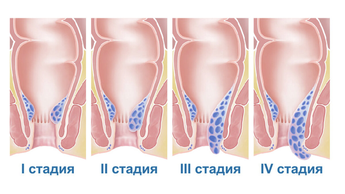 Врач рассказал, как избавиться от геморроя и недопустить его появление 