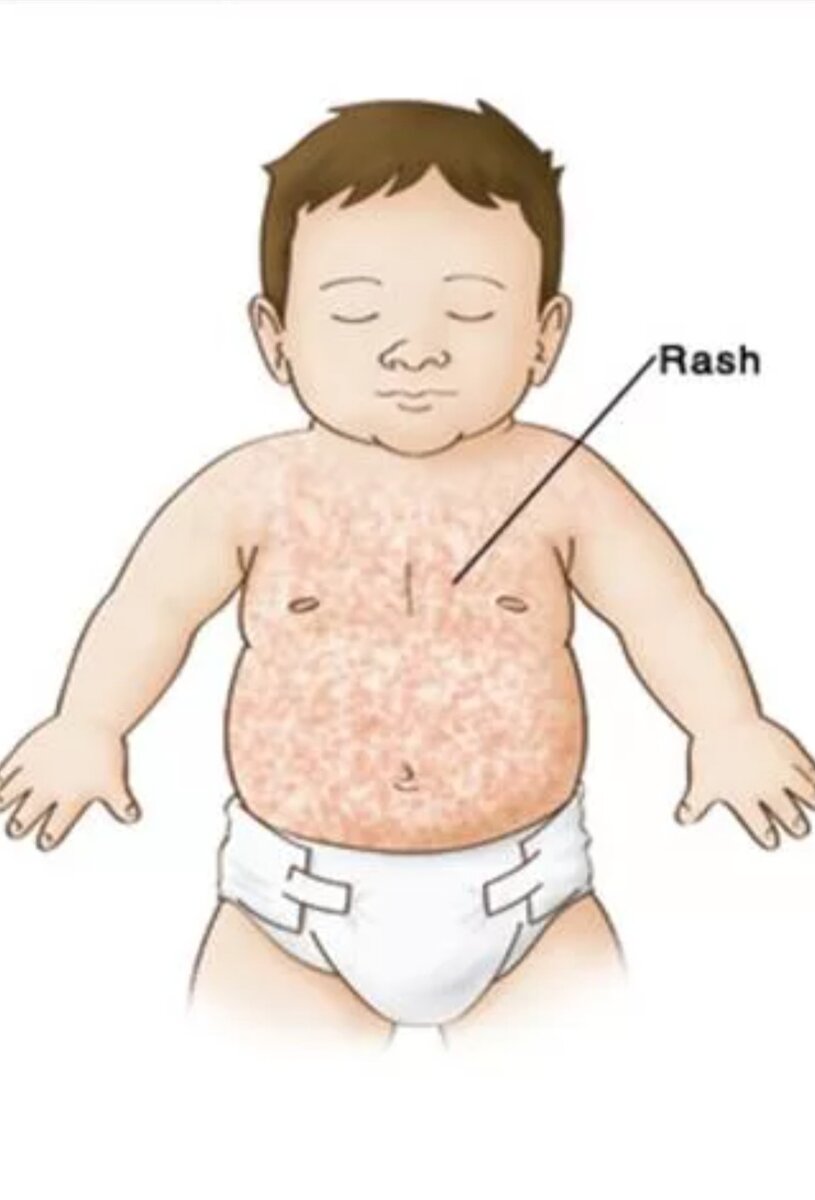 Сыпь при краснухе (из открытого источника)