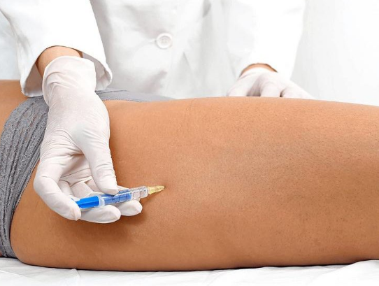  Как лечиться варикоз.