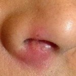 Вирус герпеса у зараженного человека постоянно находится в организме, но иммунная система его сдерживает. Причины появления водянистых высыпаний кроются в воздействии на иммунитет сильного патогенного агента, тогда он больше не в силах подавлять инфекцию.