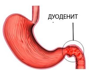 Язва двенадцатиперстной кишки