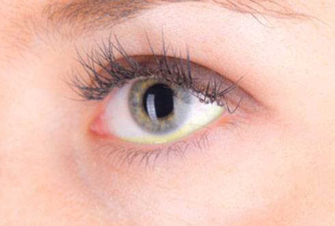Желтые глаза — причины и диагностика заболеваний