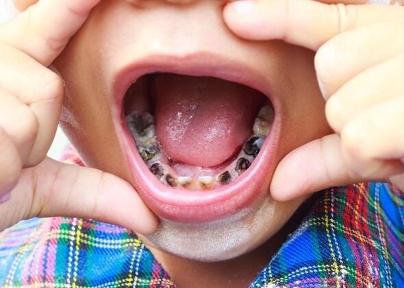 Причины, по которым крошатся зубы у детей