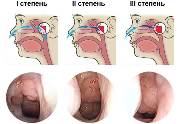Эндоскопический осмотр носоглотки