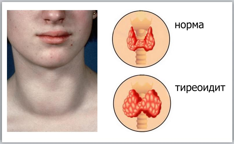 Как выглядит щитовидка фото